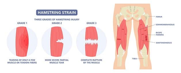 common lacrosse goalie injuries